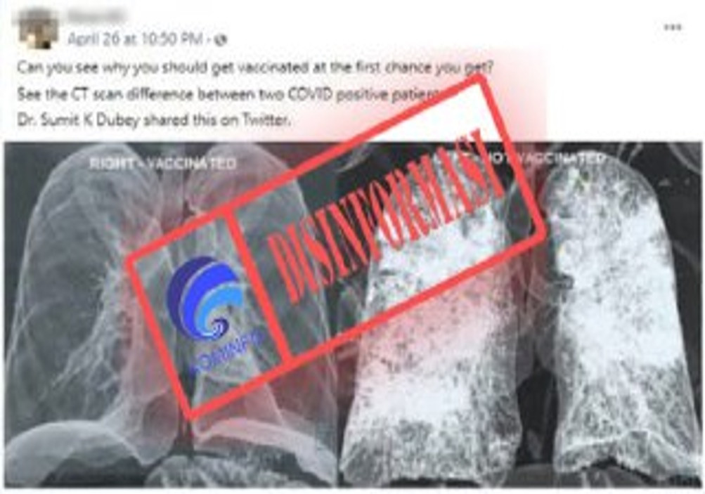 [DISINFORMASI] Foto CT Scan Paru-paru Pasien setelah Menerima Vaksin Corona